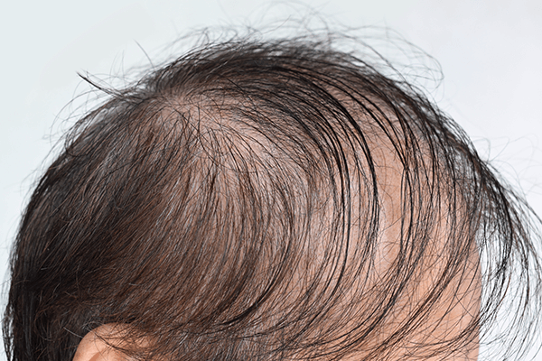 薄毛の種類と症状とは？