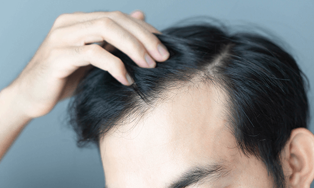 薄毛（ハゲ）、若ハゲの原因と対策について 予防法・治療法を解説